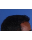 After Hair Transplant&nbsp;Front